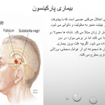 پاورپوینت اختلالات مغز در سالمندان